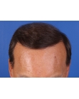 After Hair Transplant&nbsp;Front